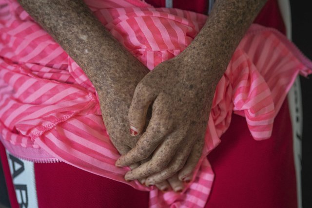 Ein Mädchen in Marokko, das an der seltenen Hautkrankheit Xeroderma Pigmentosum leidet, wartet auf eine Behandlung. Betroffene müssen das Sonnenlicht meiden, da sich die Haut nach Schäden durch UV-Strahlung nicht regenerieren kann.